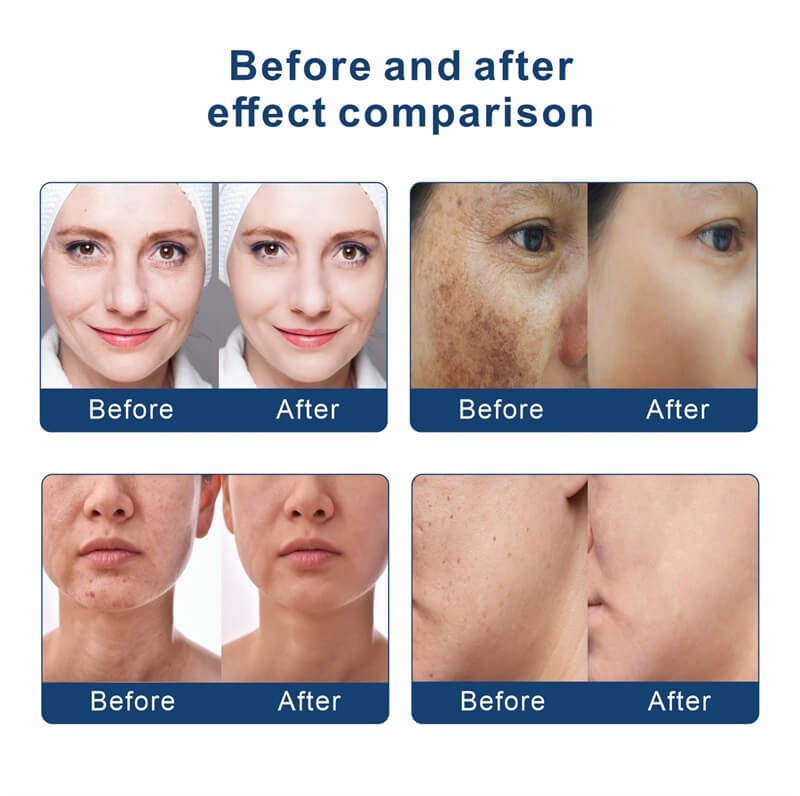 effect of ozone plasma facial