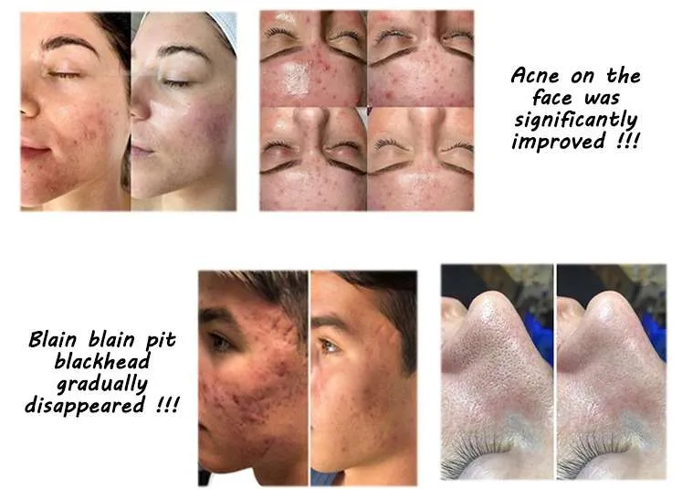hydrodermabrasion treatment