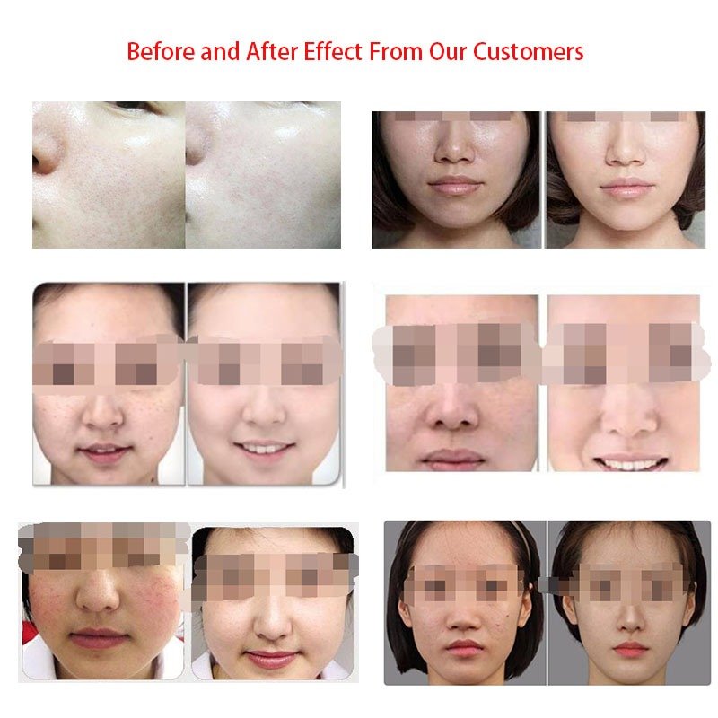 hydrodermabrasion effect