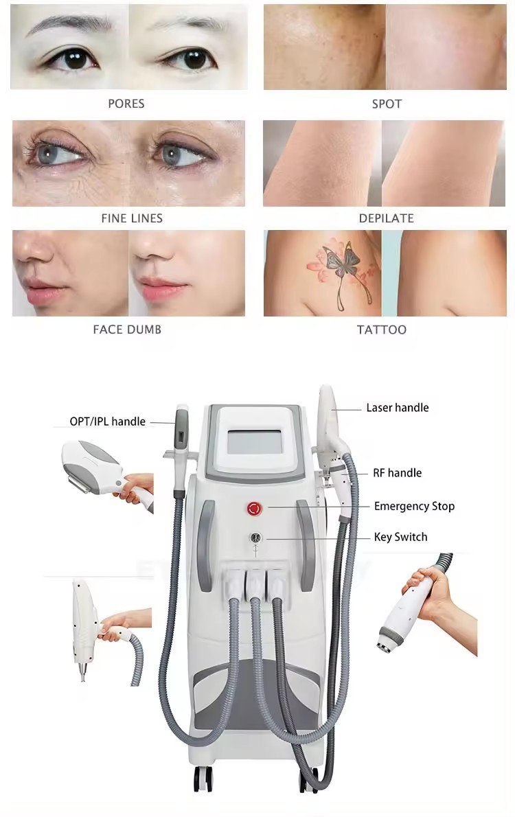 ipl laser sun spots