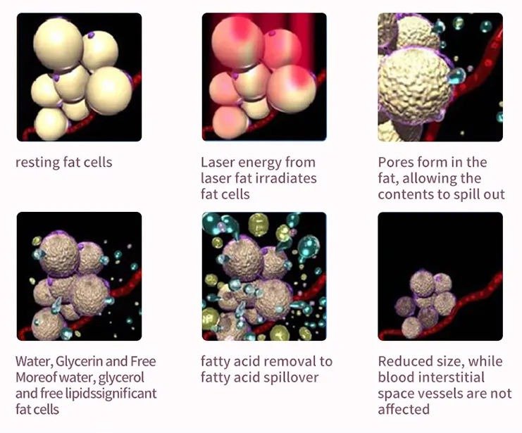 laser lipolysis