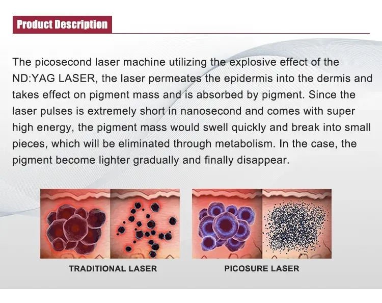 laser tattoo removal machine