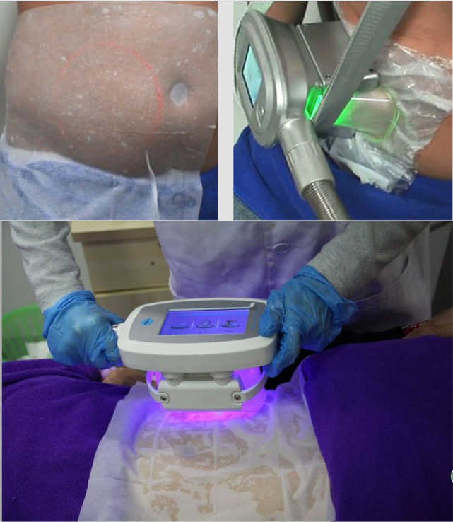 cryolipolysis pad