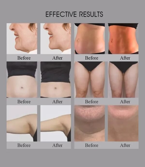 truSlim RF monopolar (5) effect of Doris TruSculpt